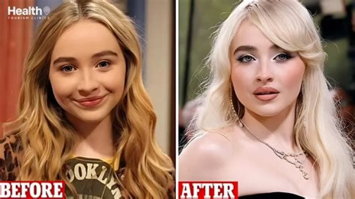 Unraveling The Mystery: Does Sabrina Carpenter Have Lip Fillers?