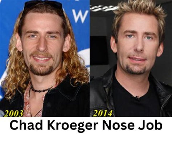 Unveiling The Truth Behind Chad Kroeger's Nose Job: A Deep Dive